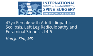 47yo Female with Adult Idiopathic Scoliosis, Left Leg Radiculopathy and Foraminal Stenosis L4-5